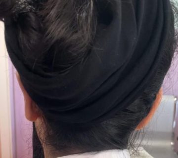 جراحی زیبایی گوش