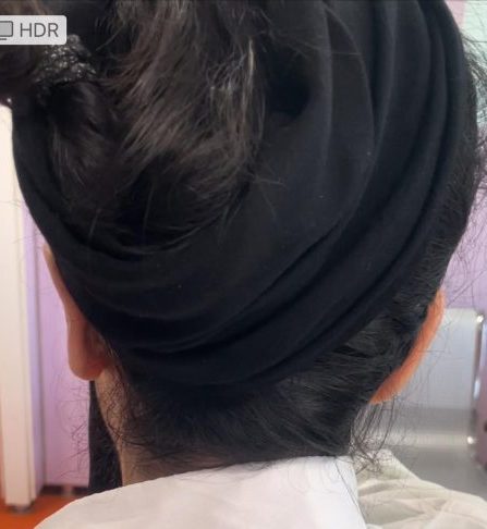 جراحی زیبایی گوش