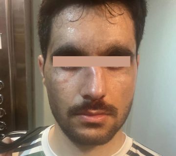 شکستگی بینی