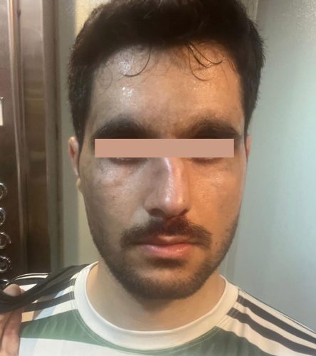 شکستگی بینی